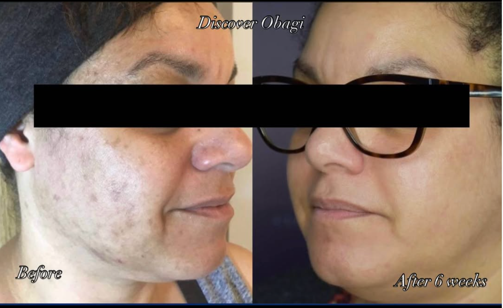 Clinic-supplied Obagi skin comparison, labelled before and after six weeks